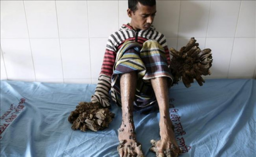 孟加拉“树人”手术成功 切除右手“树根”展笑颜