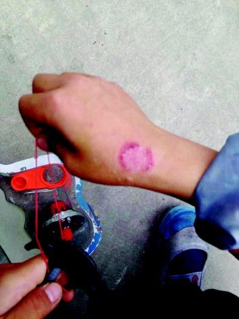 网传男童幼儿园遭老师烟头烫伤 双方达成调解协议