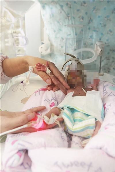 人工助孕母亲26周生下630克女婴 胳膊仅手指粗