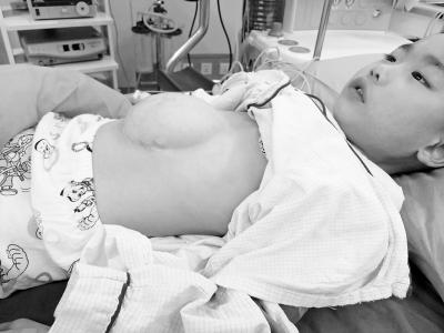 男童胃肠肝露在体外 医生电话指导护理奇迹救人