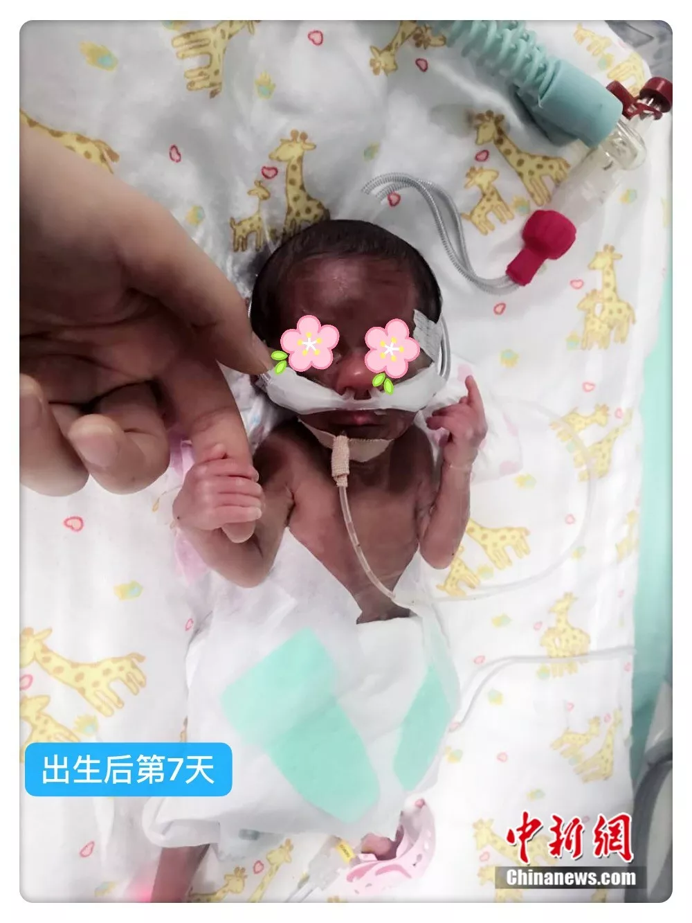 与生命的赛跑：早产宝宝出生仅570克 救助百日终存活