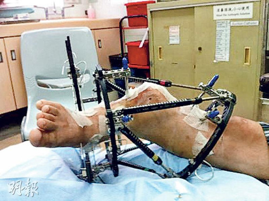 河南畸腿少年来港求医 3D支架矫正后行走自如