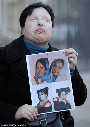 伊朗毁容女索偿200万欧元 同意不弄瞎凶手