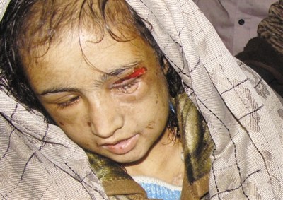 阿富汗15岁少女拒绝卖淫被婆家用烙铁烫身（图）