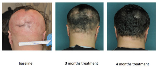 美国研究发现新药可能让斑秃患者毛发再生(图)