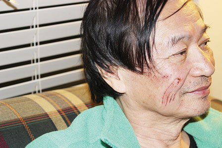 中国侨网徐先生向记者展示脸颊及双手伤痕。（加拿大《明报》/张伶铢 摄）