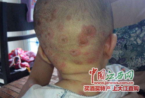 婴儿生脓疱疮疑被误诊水痘 江西省儿童医院遭投诉