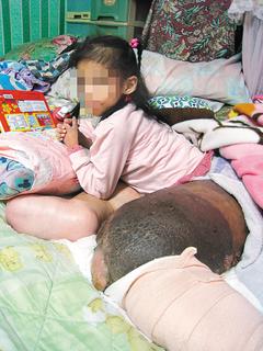 台灣9歲女童患罕見疾病 左腿腫成身體兩倍大(圖)