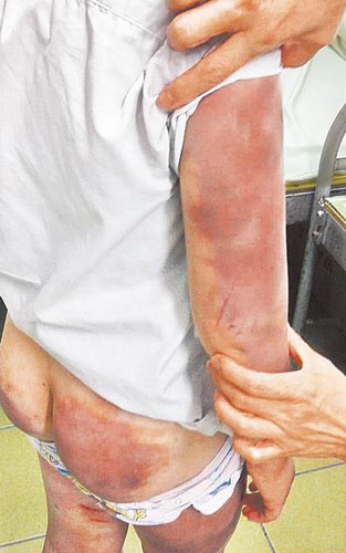 台灣一男童遭父親與繼母聯手淩虐全身瘀傷（圖）（2）