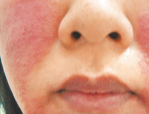 台湾女子敷面膜脸红肿脱皮医师提醒勿超20分