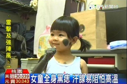 台湾2岁女童患罕见病全身10%皮肤长黑痣（图）