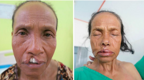 印尼妇人“脸破”59年台医生1小时巧手“缝补”