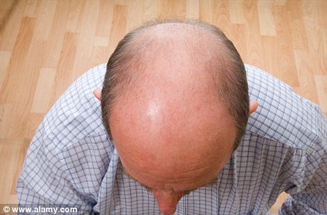 科学家发现阻碍生发物质 治秃顶药或5年内问世-中新网