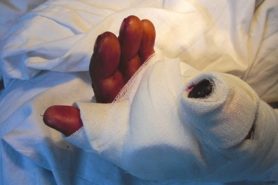 民工断指住院包工头避而不见 医生替其求助(图)