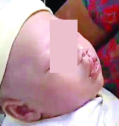 生下婴儿却唇腭裂 家人诉医院索赔 |b超显示"唇线连续",却产下兔唇儿