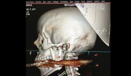 这名巴西女子不慎将鱼叉摄入嘴中。 这名巴西女子不慎将鱼叉摄入嘴中。