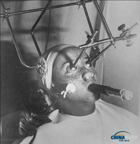 ������30��������ö�����̼��������ȸ�ߡ���ʵʩ��������ʱ�����˵��۾�Ҫ�ò�͸�������ӱ���ס���ǿ�ҲҪ�����ϡ���˲��˲��ò�ͨ�����Ӻ�����