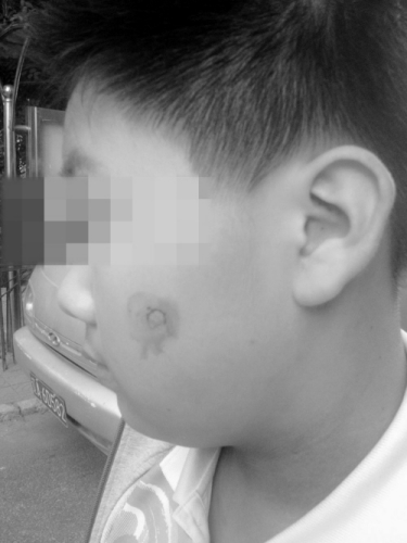 被烫伤的男孩脸上留有伤疤
