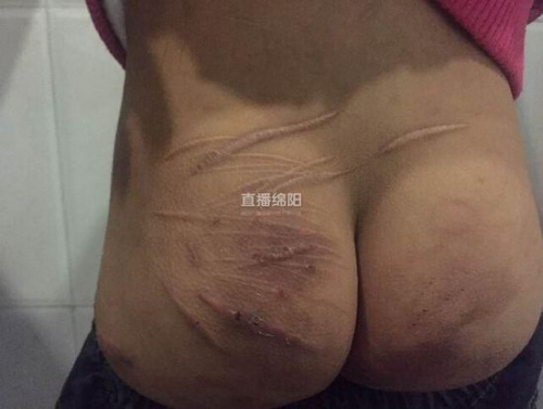 小琪身上满身是伤 小琪身上满身是伤