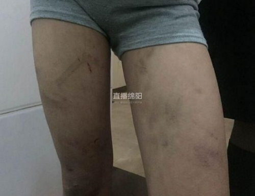 小琪身上的疤痕 小琪身上的疤痕