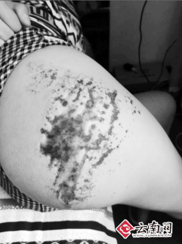 公共场所用火碱洗地 少女夜路摔一跤被灼伤(图)