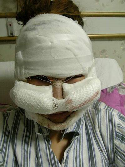 自体脂肪丰额头,磨颧骨和隆鼻