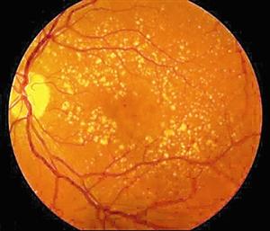 发生年龄相关性黄斑变性的眼睛.