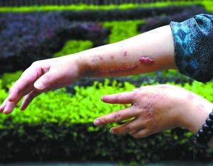 女子借住小区电梯里遭抢被砍伤 状告物管索赔