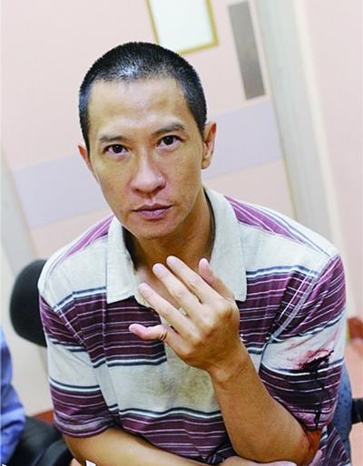 张家辉拍片被打断手指 自己都不敢看