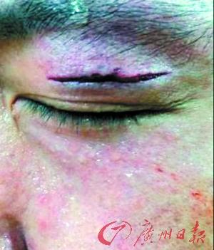 大郅备战全运会险些瞎眼 眼部受伤缝10针(图)