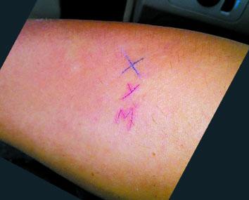 外企主管为挽留女友 将其名字首字母刻在手臂(图)