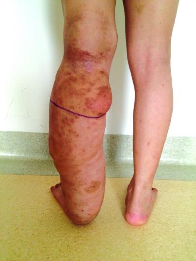 男子腿上的肿瘤触目惊心