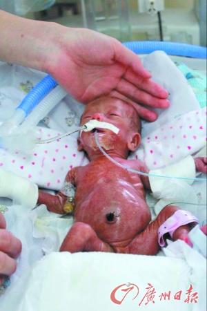 广东最轻早产儿闯过难关存活 出生时仅550克