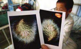 1��5�գ�����ʡ��ͯҽԺ�����֣���������������µ���Ƭ����ʾ��ͷ���к��ײ�����Ѫ��ͼ/IC