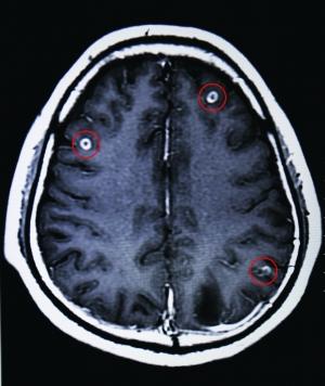 男子脑中寄生19条虫头晕无力视力模糊图