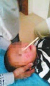 被筷子插伤的孩子接受治疗。