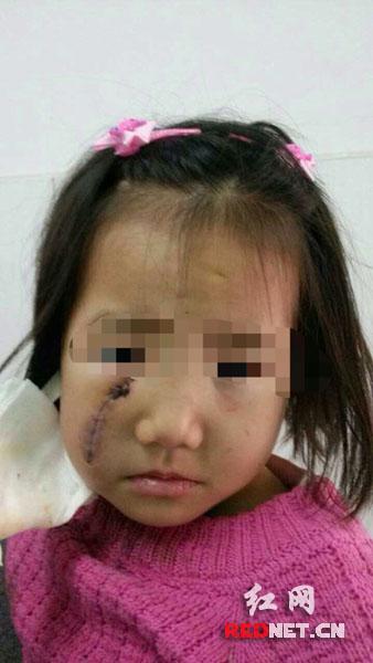 毁容女孩翠翠(化名)
