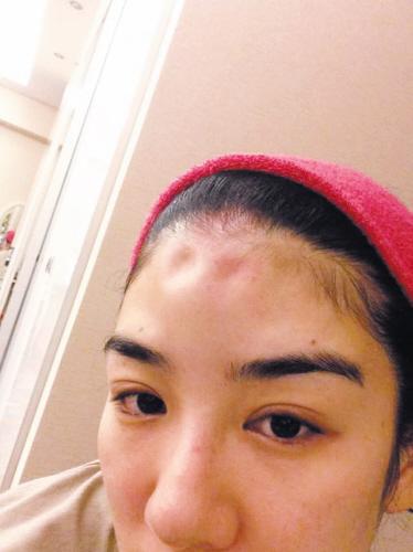 黄奕贴出额头有两个坑的照片.