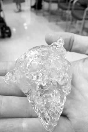 3d打印心脏救活两周大婴儿 可过上正常生活(图)