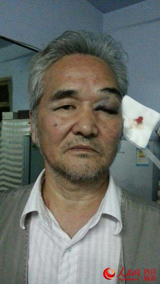 四川70岁老人到社区办事被工作人员打成"熊猫眼"