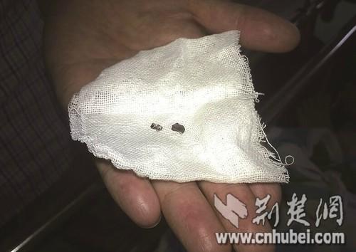 图为:从伤者体内取出的弹片