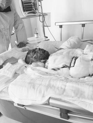 少年遭变压器电击 全身烧伤左臂截肢(图)