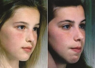 专家:儿童长期"张嘴睡",会变丑还影响智力