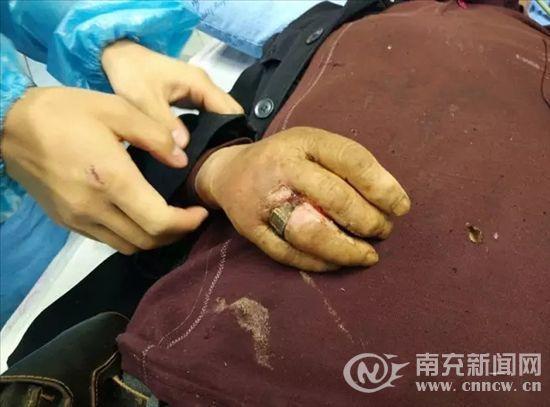 老人金戒指戴20年长进肉里 消防用电锯解困(图)