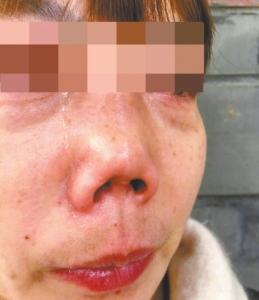 杨女士过年前做了隆鼻术,术后鼻子变异样.
