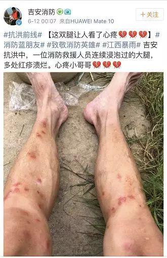 好心疼网友看了大呼:多处红疹溃烂一位消防救援人员连续浸泡过的大腿
