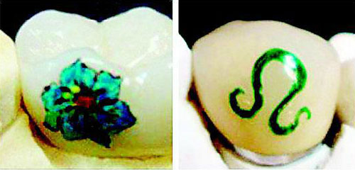 牙齿文身在美国流行文牙“寿命”可达数年(图)