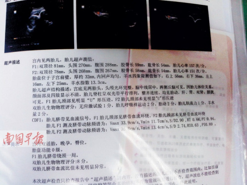 没检出畸形    相关专家表示:成熟的b超技术完全可以检出胎儿连体