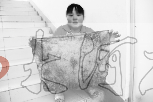 医生为女子接生留其下体一块布已与肉长一起(图)