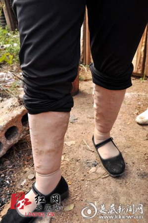 周阿姨小腿上布满了大大小小的脂肪瘤